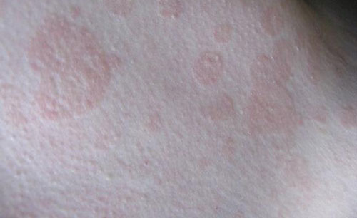 Из-за каких заболеваний появляются на поверхности кожи пятна розового цвета