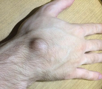 Откуда берется твердая шишка сверху запястья на руке