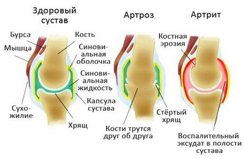 Почему появляется артроз и артрит суставов