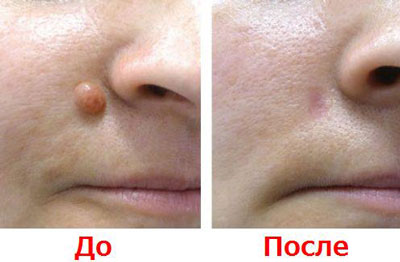 Как лечить фиброму на лице
