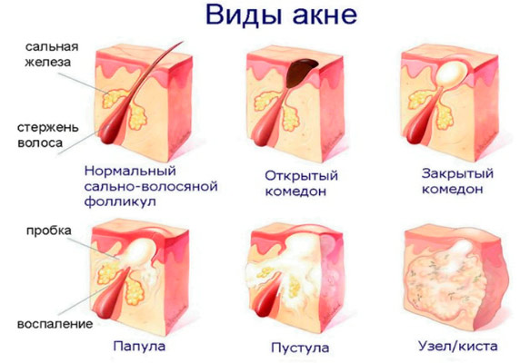 Подкожные прыщи (угри) на лице: фото видов