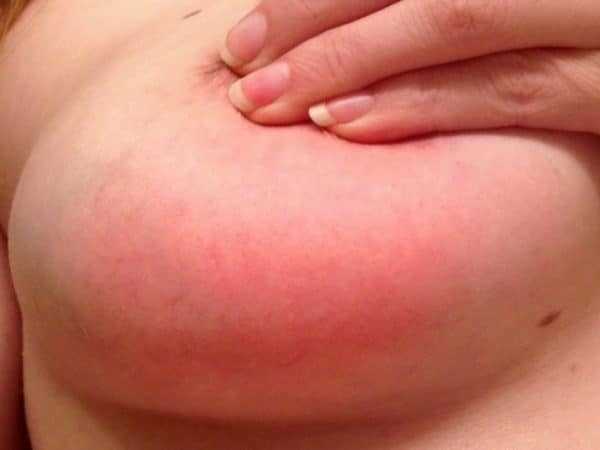 Лактостаз у кормящей мамы: что делать, симптомы и лечение в домашних условиях, причины застоя молока0