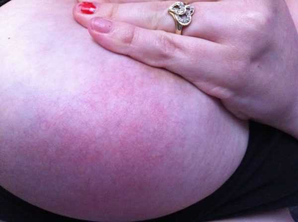 Мастит у кормящей матери: причины, симптомы, лечение в домашних условиях и профилактика2