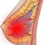 Сдавление молочной железы при грудном вскармливании: причины, лечение, отличия лактостаза от мастита3
