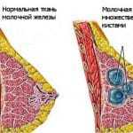 Сдавление в молочной железе при грудном вскармливании: причины, лечение, отличия лактостаза от мастита4