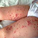 Золотистый стафилококк в грудном молоке кормящей матери: анализ, симптомы, лечение, причины