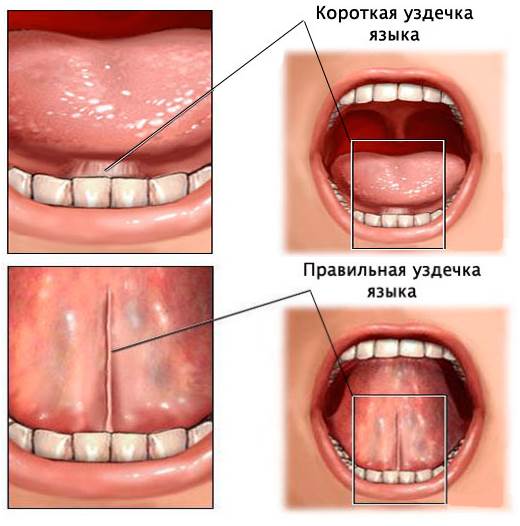 Уздечка языка
