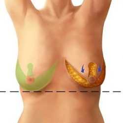 Ассиметрия груди Ассиметрия груди средней степени