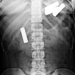 Батарейки на рентгене Рентген для определения батареек в организме