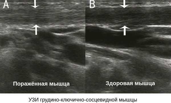 УЗИ мышц шеи УЗИ мышц шеи